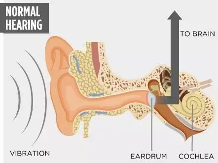 Bone Conduction Headphones Use With Existing Tinnitus And Hearing Loss